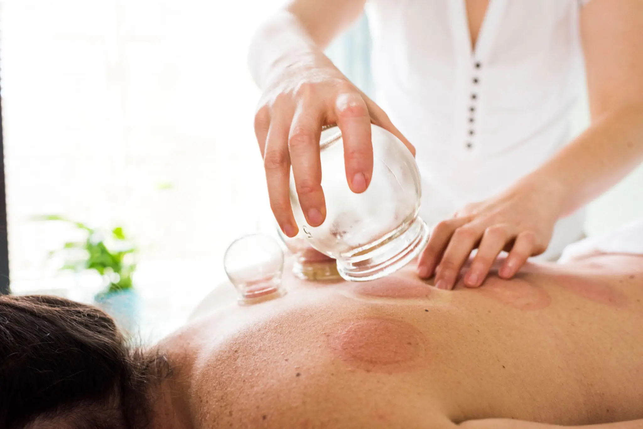 Cupping therapy being applied on a person's back.