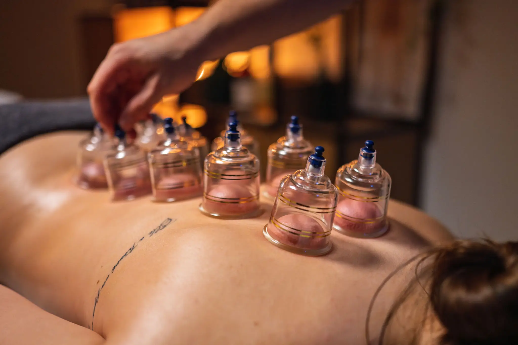Person receiving cupping therapy with glass cups on their back.